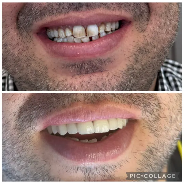 Avant / après — facettes & esthétique réalisée au cabinet Boukhal Dental Clinic, Rabat