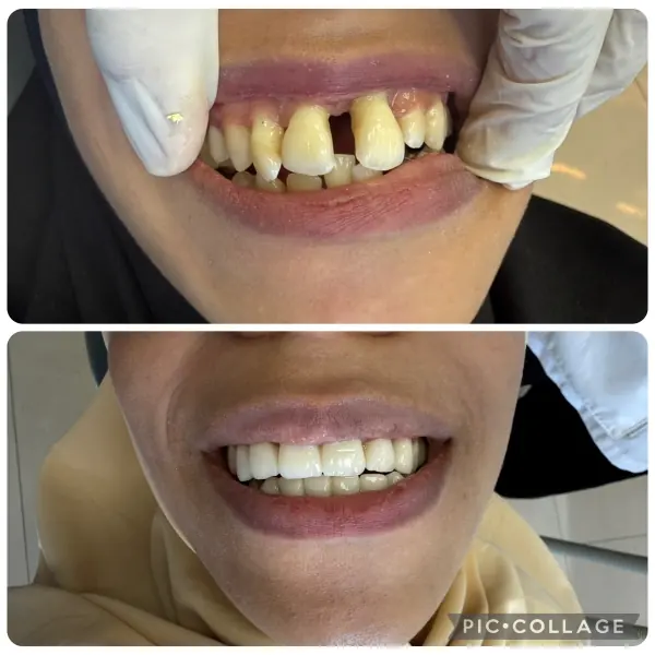 Avant / après — remplacement dentaire réalisée au cabinet Boukhal Dental Clinic, Rabat