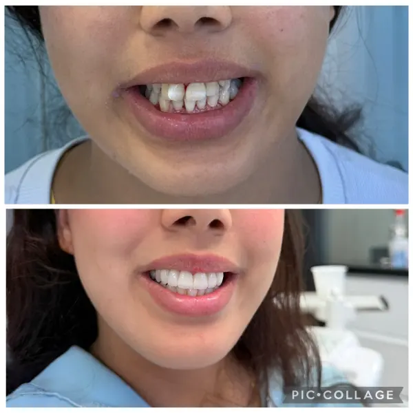 Avant / après — alignement & esthétique réalisée au cabinet Boukhal Dental Clinic, Rabat