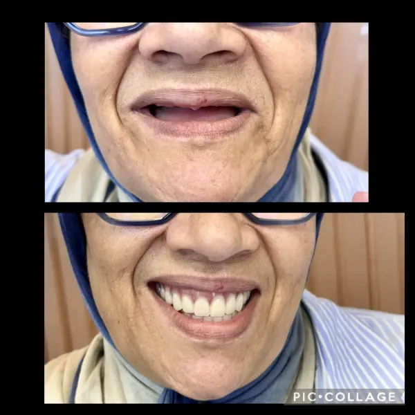Avant / après — réhabilitation du sourire réalisée au cabinet Boukhal Dental Clinic, Rabat