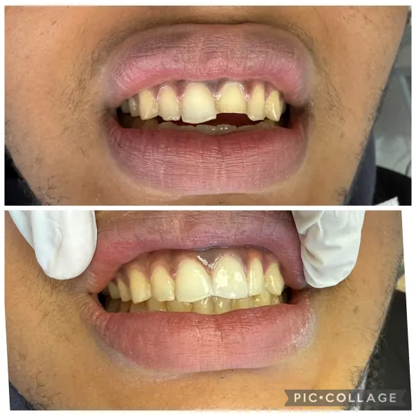 Avant / après — restauration antérieure réalisée au cabinet Boukhal Dental Clinic, Rabat