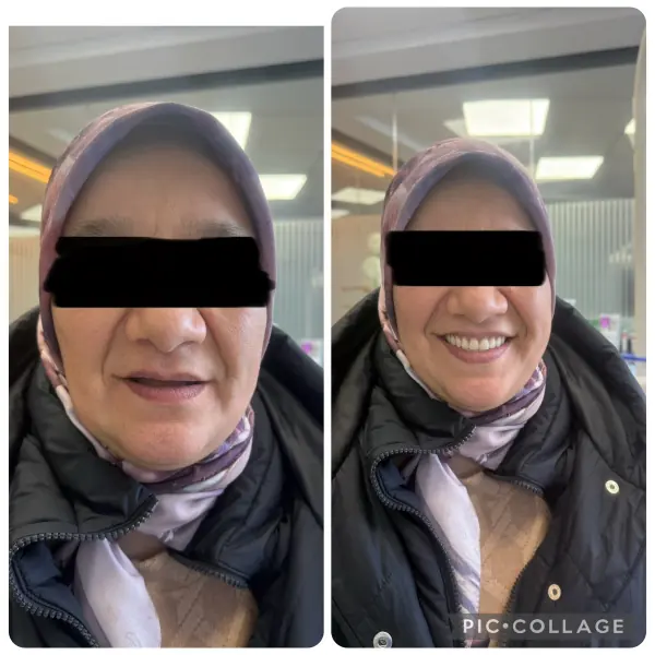 Avant / après — nouveau sourire réalisée au cabinet Boukhal Dental Clinic, Rabat