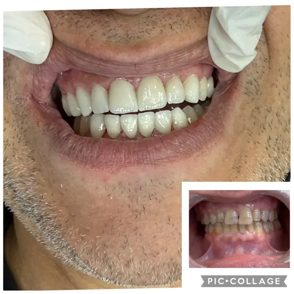 Avant / après — réhabilitation esthétique réalisée au cabinet Boukhal Dental Clinic, Rabat