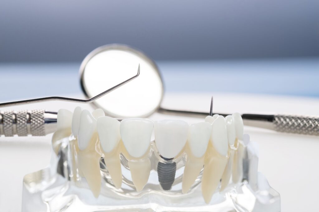 Retrouver ses dents : tout savoir sur l’implantologie et les prothèses