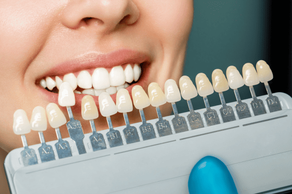 Facettes céramique vs composite : différences et avantages